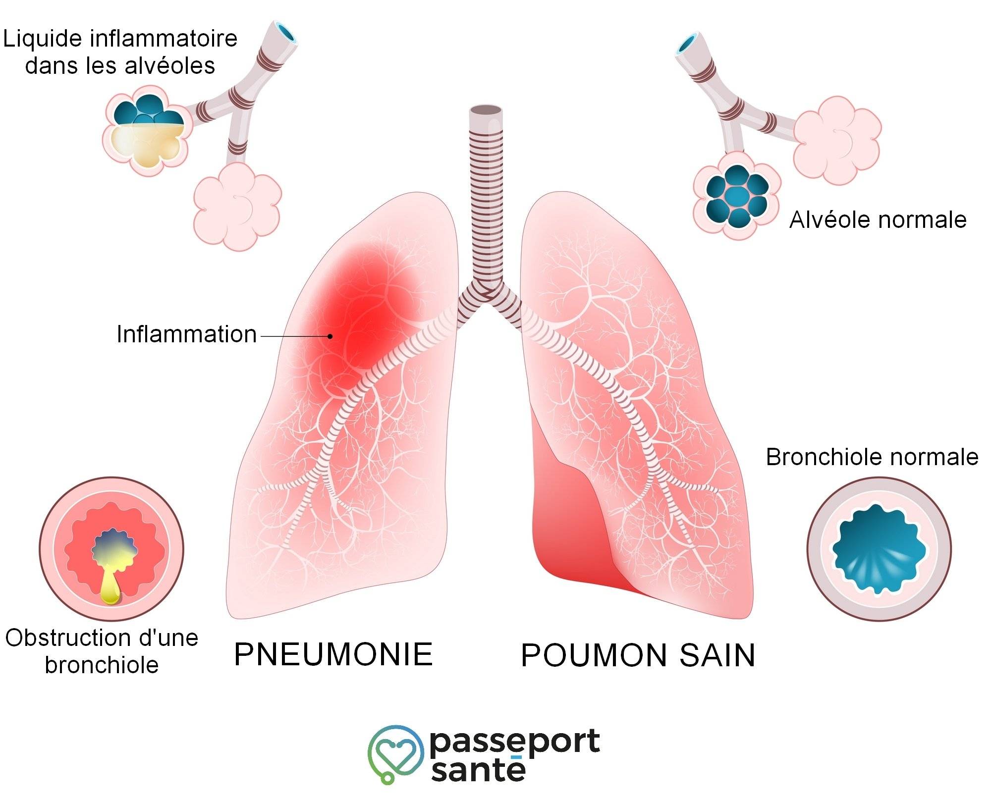 Pneumonie : comment savoir si la rhinite est une complication ?